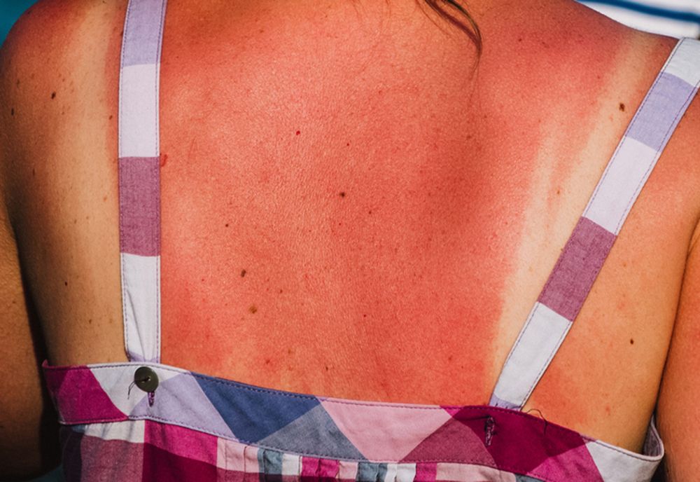 Ce alimente te scapă de arsurile solare