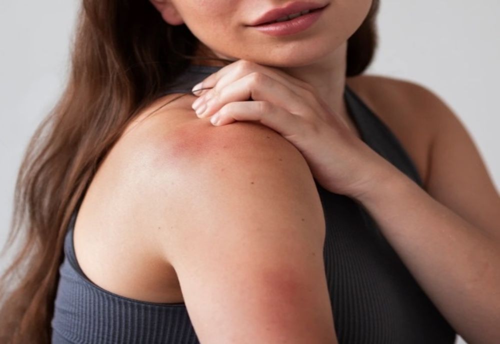 SEMNELE ÎNGRIJORĂTOARE CĂ AI FOST MUȘCAT DE O CĂPUȘĂ