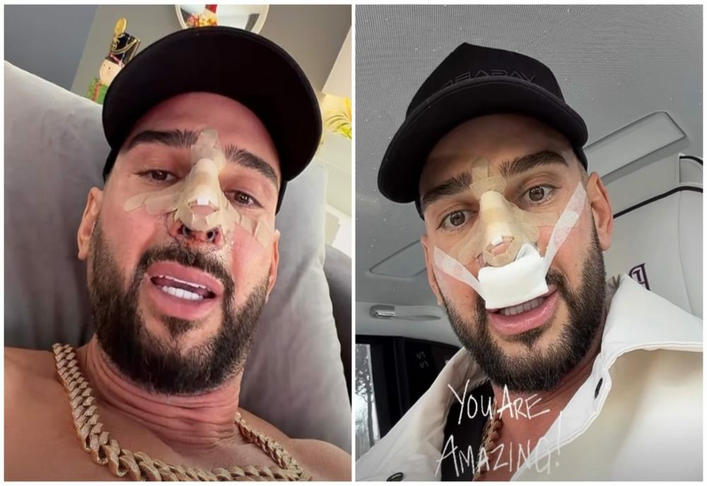 Cum arată nasul lui Dorian Popa după operație. Influencerul și-a dat bandajele jos