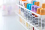 România, printre țările europene cu cele mai multe diagnostice HIV tardive