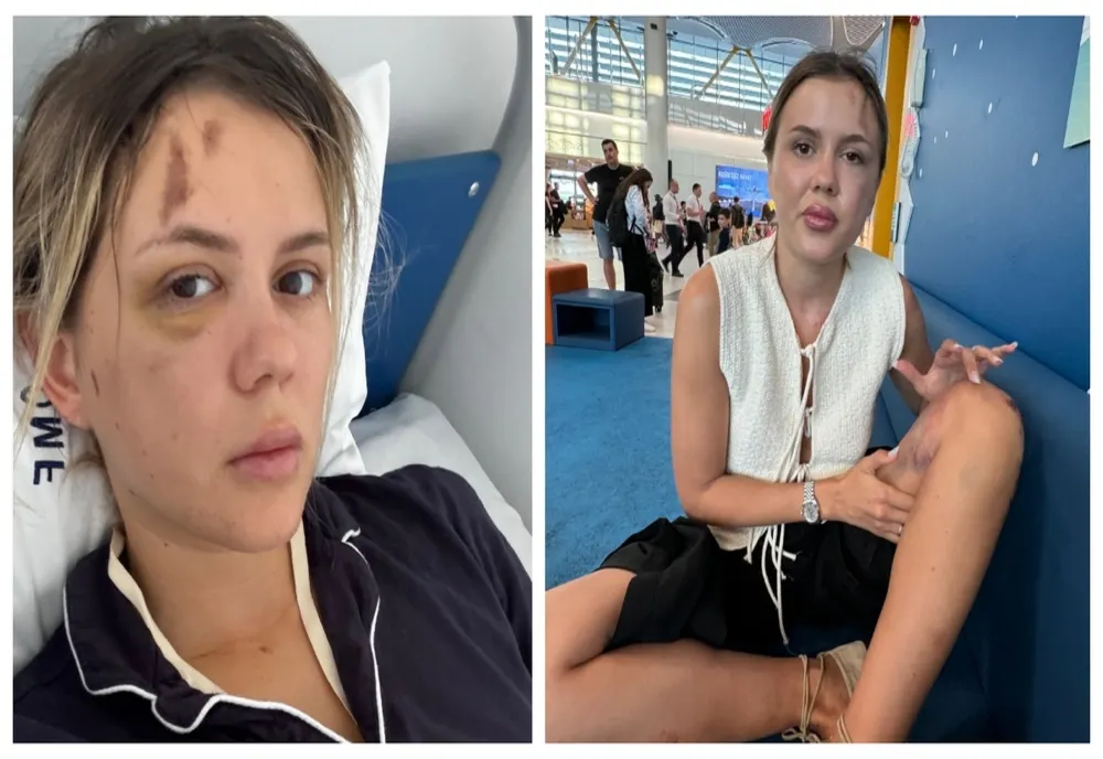 CU CE PROBLEME SE CONFRUNTĂ EMILY BURGHELEA LA CÂTEVA SĂPTĂMÂNI DE LA CUMPLITUL ACCIDENT