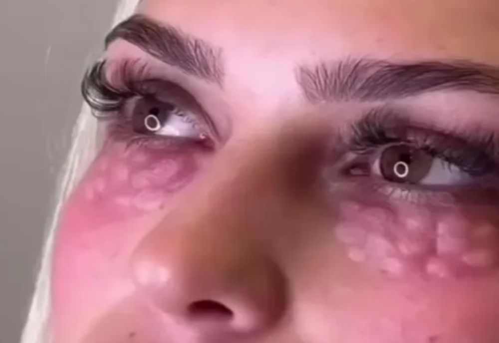 „Chip de reptilă” - tendința cosmetică periculoasă care te poate orbi 