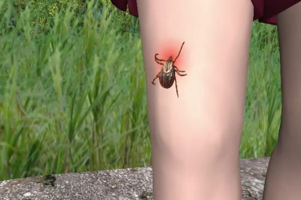 Cum te ferești de căpușe când ieși la iarbă verde și ce faci când ești mușcat