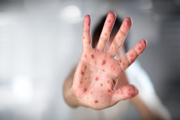 EPIDEMIE de RUJEOLĂ în România. Cum te poți proteja de această afecțiune contagioasă