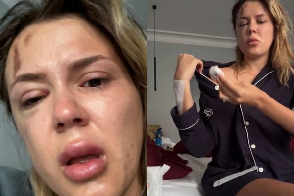 Emily Burghelea, pe masa de operații, după accidentul de mașină