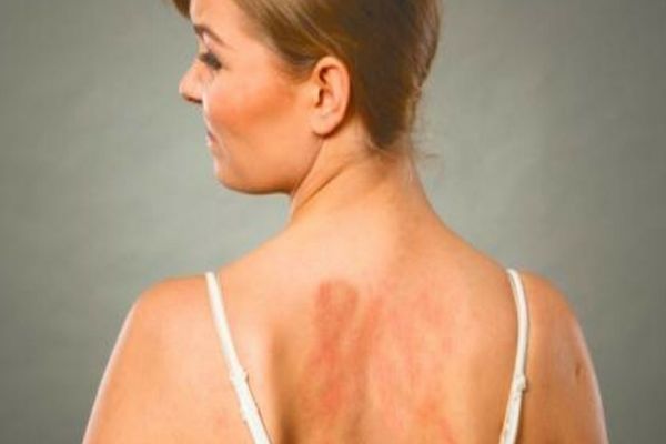 CE ESTE ALERGIA LA SOARE ȘI CUM O ȚII SUB CONTROL