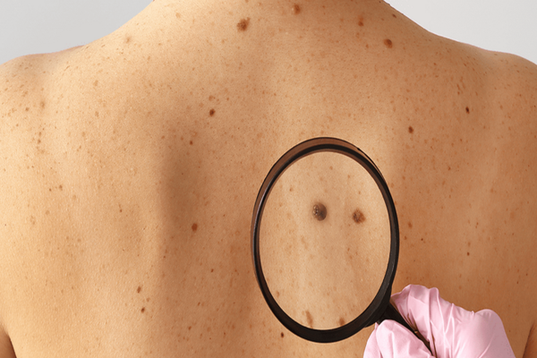 Trendul periculos de pe TikTok care poate crește riscul de cancer de piele