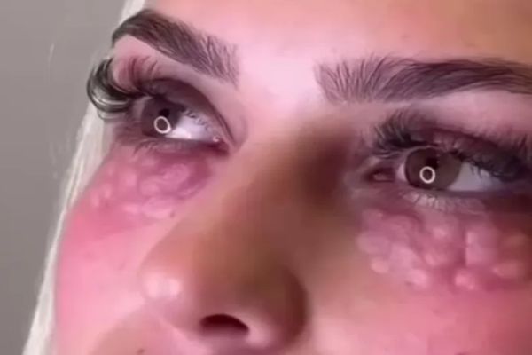 „Chip de reptilă” - tendința cosmetică periculoasă care te poate orbi 