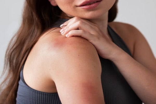 SEMNELE ÎNGRIJORĂTOARE CĂ AI FOST MUȘCAT DE O CĂPUȘĂ