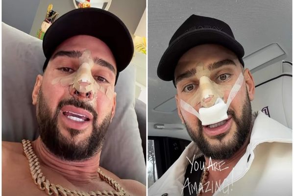 Cum arată nasul lui Dorian Popa după operație. Influencerul și-a dat bandajele jos